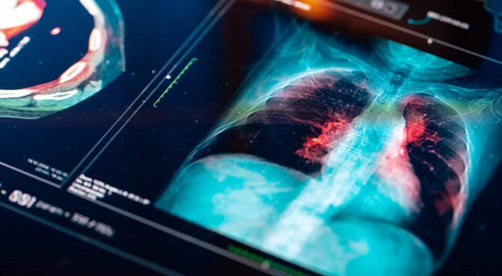 Focus ordo’ : pneumopathie aiguë communautaire de l’adulte